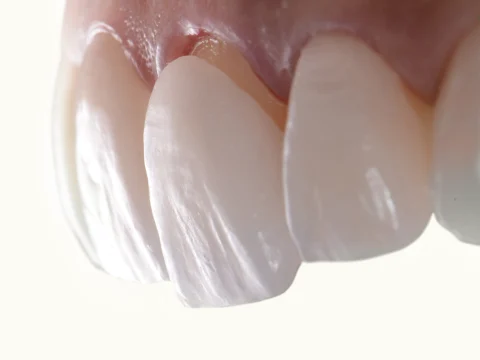 Best Veneer Types For Yellow Teeth