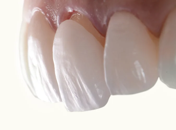Best Veneer Types For Yellow Teeth Best Veneer Types For Yellow Teeth