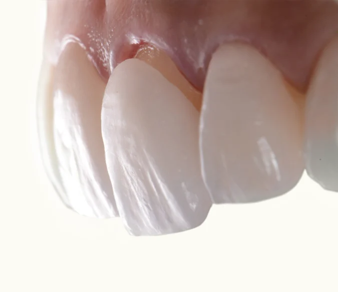 Best Veneer Types For Yellow Teeth